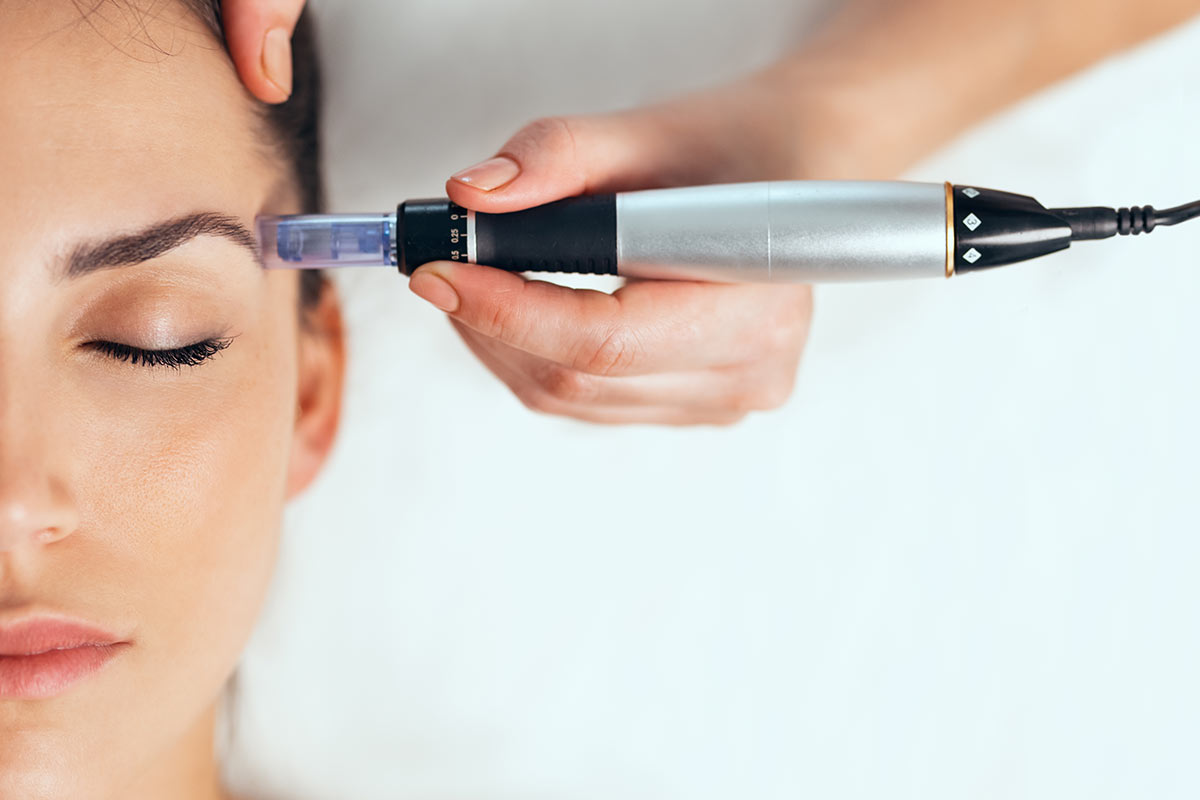 micro needling under eye