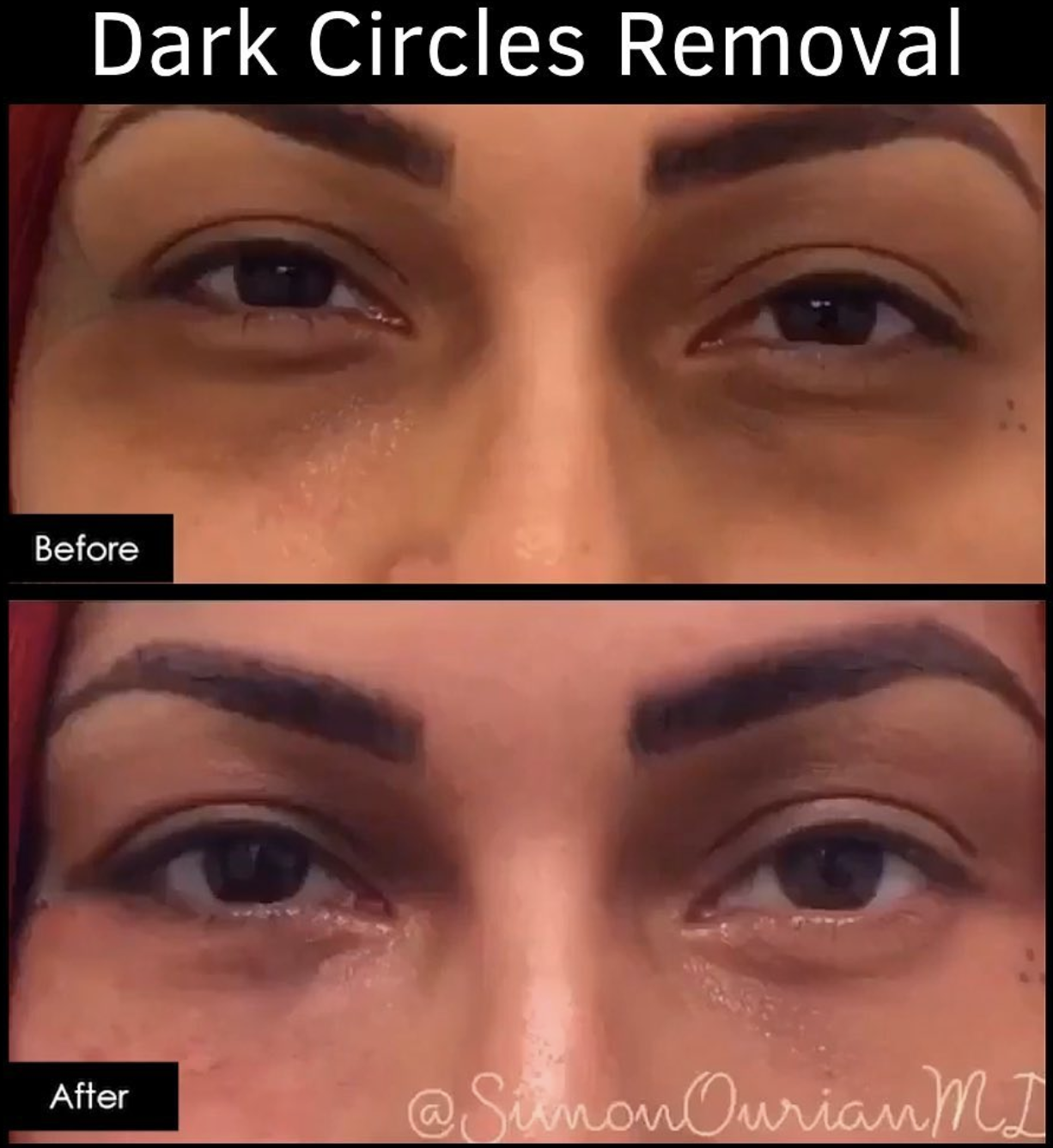 best eye cream dark circles and wrinkles