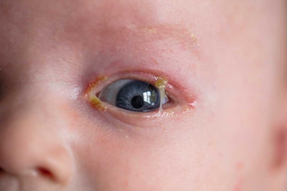 infant yellow eye discharge