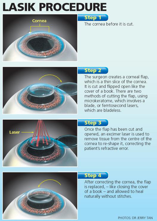 laser eye surgery houston