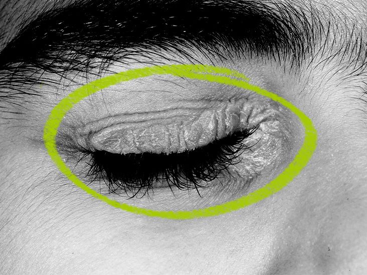 psoriasis on eye lids