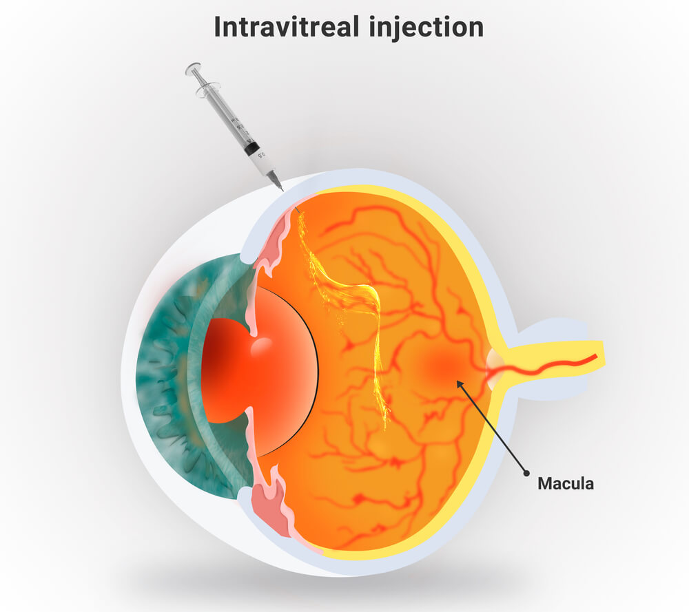 macular degeneration injections in the eye