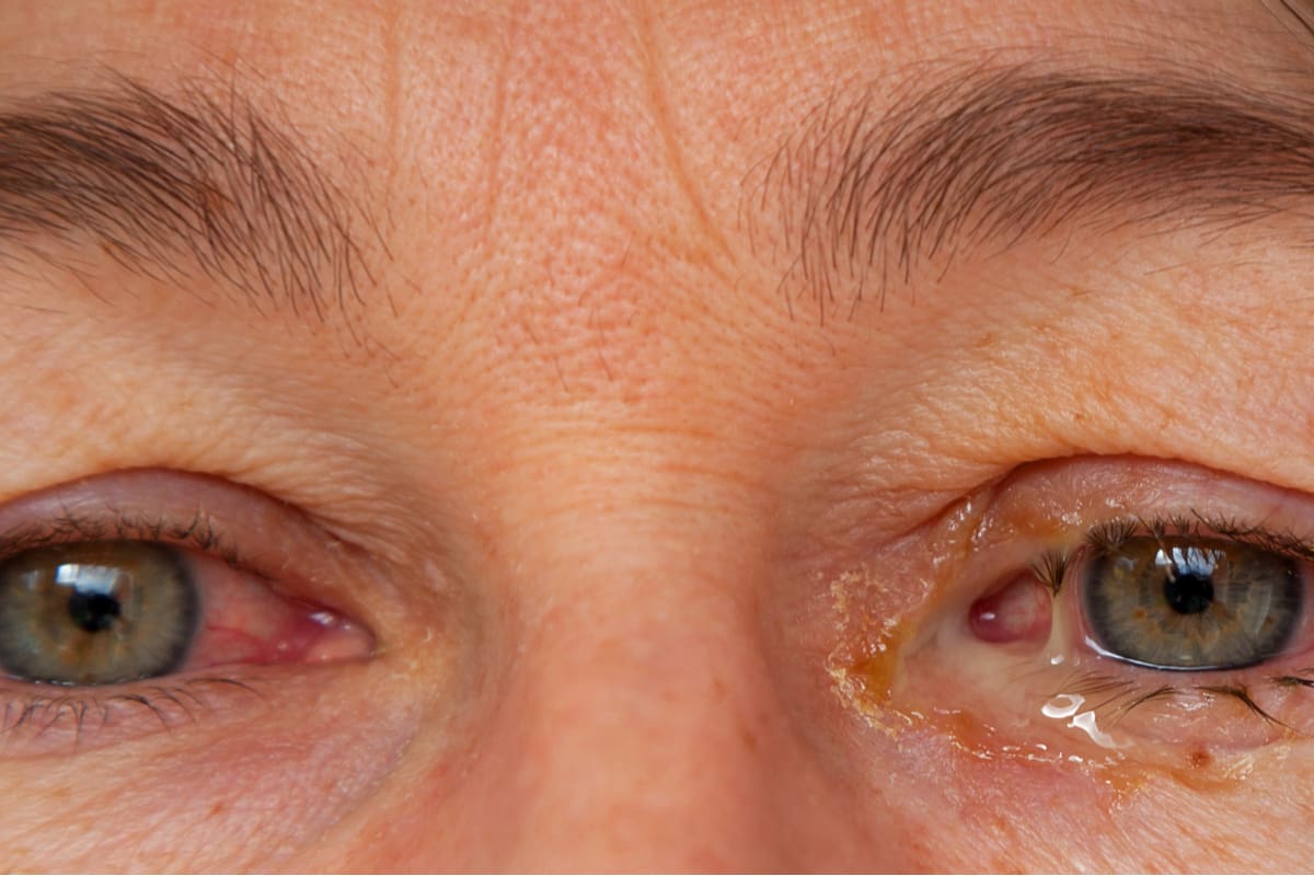 sinus infection with eye discharge