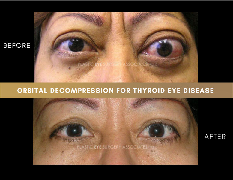 thyroid eye pictures