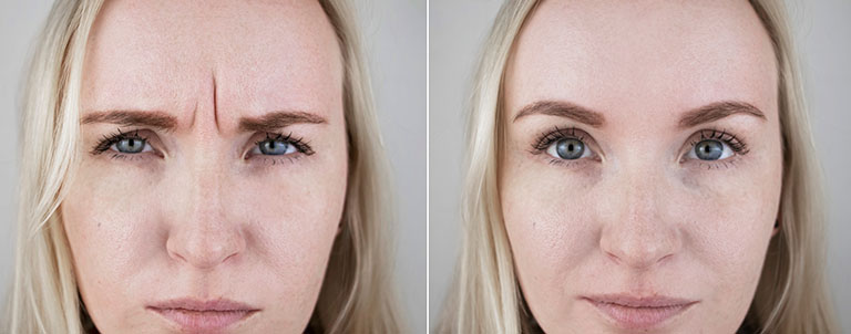 before and after eye botox