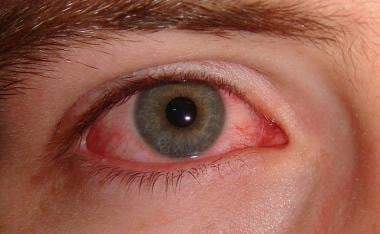 virus pink eye