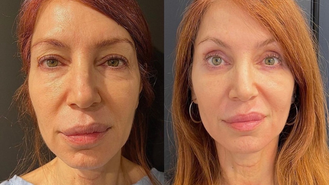 upper eye lift cost