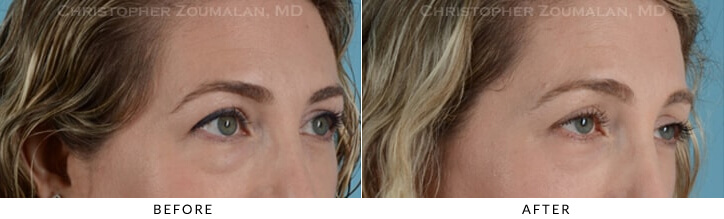 lower eye surgery before and after