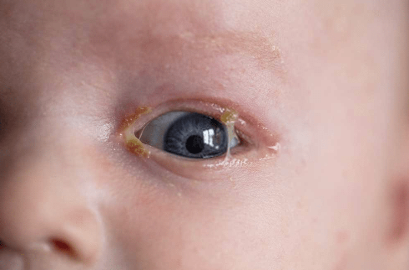 yellow eye discharge infant