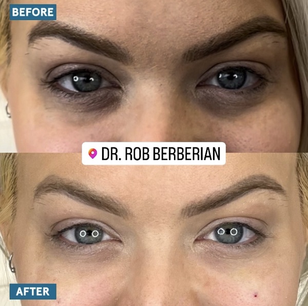 eye trough filler before and after